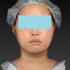 新宿ラクル美容外科クリニック　山本厚志　「ライポライフ脂肪吸引（ジョールファット+あご下）」　手術後１２ヶ月目　２月２１日