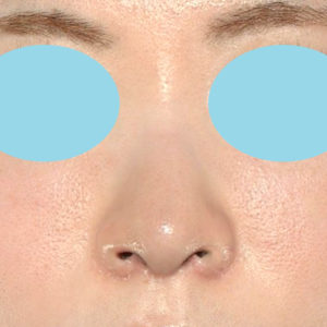 新宿ラクル美容外科クリニック　山本厚志　「小鼻縮小+α法 ＋ 鼻孔縁下降術」　手術後１ヶ月目　８月１２日