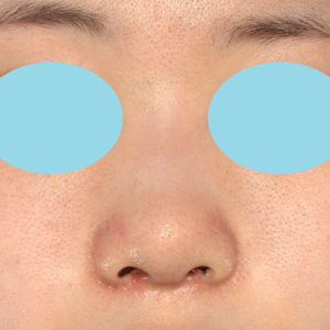 「小鼻縮小+α＋鼻尖縮小（close法）」　新宿ラクル美容外科クリニック　２０代女性　手術後１ヶ月目　８月１９日