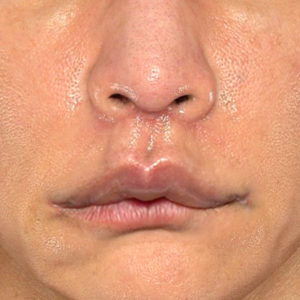 新宿ラクル美容外科クリニック　山本厚志　「人中短縮術（リップリフト）＋口角挙上（スマイルリップ）」　手術後１ヶ月目　８月２０日