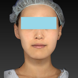 新宿ラクル美容外科クリニック　山本厚志　「アルテミスリフト」　手術後１ヶ月目　８月５日