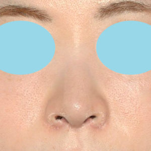 新宿ラクル美容外科クリニック　山本厚志　「小鼻縮小+α法 ＋ 鼻孔縁下降術」　手術後２ヶ月目　８月１２日