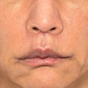 新宿ラクル美容外科クリニック　山本厚志　「人中短縮術（リップリフト）＋口角挙上（スマイルリップ）」　手術後２ヶ月目　８月２０日