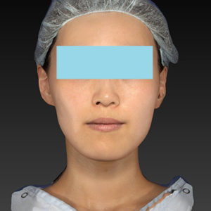 新宿ラクル美容外科クリニック　山本厚志　「アルテミスリフト」　手術後２ヶ月目　８月５日