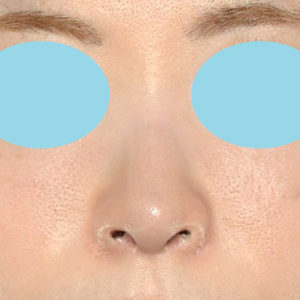 新宿ラクル美容外科クリニック　山本厚志　「小鼻縮小+α法 ＋ 鼻孔縁下降術」　手術後３ヶ月目　８月１２日