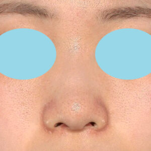 「小鼻縮小+α＋鼻尖縮小（close法）」　新宿ラクル美容外科クリニック　２０代女性　手術後３ヶ月目　９月１２日