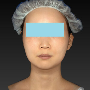 新宿ラクル美容外科クリニック　山本厚志　「アルテミスリフト」　手術後６ヶ月目　９月２４日