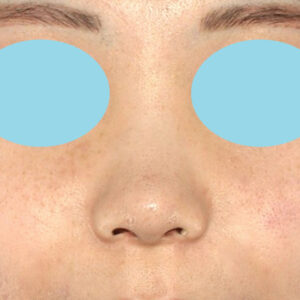 「耳介軟骨移植＋鼻尖縮小（close法）＋小鼻縮小+α」　新宿ラクル美容外科クリニック　２０代女性　手術後６ヶ月目　９月２６日