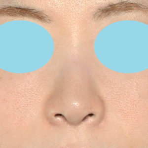 新宿ラクル美容外科クリニック　山本厚志　「小鼻縮小+α法 ＋ 鼻孔縁下降術」　手術後６ヶ月目　８月１２日