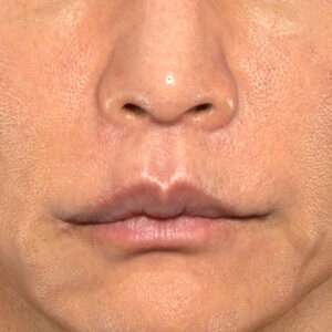 新宿ラクル美容外科クリニック　山本厚志　「人中短縮術（リップリフト）＋口角挙上（スマイルリップ）」　手術後６ヶ月目　１１月7日