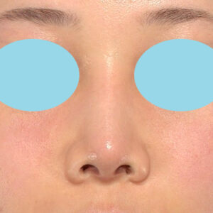 「耳介軟骨移植＋鼻尖縮小（close法）＋鼻プロテーゼ隆鼻術＋ハンプ切除＋猫手術＋真皮脂肪移植（鼻尖）」　新宿ラクル美容外科クリニック　２０代女性　手術後６ヶ月目　２月９日