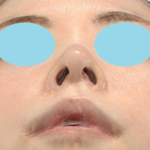 新宿ラクル美容外科クリニック　山本厚志　「小鼻縮小+α法 ＋ 鼻孔縁下降術」　手術前　８月１２日