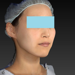 新宿ラクル美容外科クリニック　山本厚志　「アルテミスリフト」　手術前　８月５日