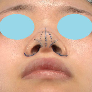 「小鼻縮小+α＋鼻尖縮小（close法）」　新宿ラクル美容外科クリニック　２０代女性　デザイン　８月１９日