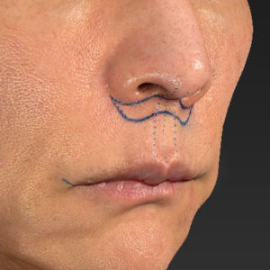 新宿ラクル美容外科クリニック　山本厚志　「人中短縮術（リップリフト）＋口角挙上（スマイルリップ）」　デザイン　８月２０日