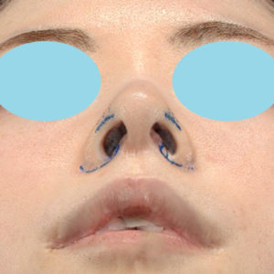 新宿ラクル美容外科クリニック　山本厚志　「小鼻縮小+α法 ＋ 鼻孔縁下降術」　デザイン　８月１２日