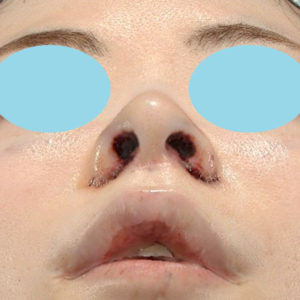 新宿ラクル美容外科クリニック　山本厚志　「小鼻縮小+α法 ＋ 鼻孔縁下降術」　手術直後　８月１２日
