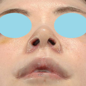 新宿ラクル美容外科クリニック　山本厚志　「小鼻縮小+α法 ＋ 鼻孔縁下降術」　手術後１週間目　８月１２日