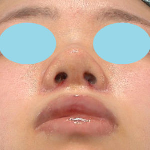 「小鼻縮小+α＋鼻尖縮小（close法）」　新宿ラクル美容外科クリニック　２０代女性　手術後１週間目　８月１９日
