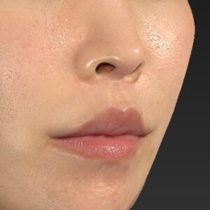 新宿ラクル美容外科クリニック　山本厚志　「人中短縮術（リップリフト）＋口角挙上（スマイルリップ）」　手術後１２ヶ月目　１２月２７日