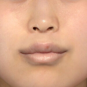 新宿ラクル美容外科クリニック　山本厚志　「猫手術（鼻唇角形成術）+ 貴族手術（鼻翼基部プロテーゼ）+ 口角挙上（スマイルリフト）+ 人中短縮術（リップリフト）」　手術後１２ヶ月目　２月１６日