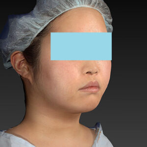 新宿ラクル美容外科クリニック　山本厚志　「ライポライフ脂肪吸引（ジョールファット+あご下）」　手術後１２ヶ月目　２月２１日