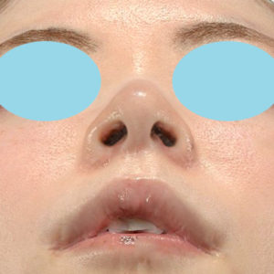 新宿ラクル美容外科クリニック　山本厚志　「小鼻縮小+α法 ＋ 鼻孔縁下降術」　手術後１ヶ月目　８月１２日