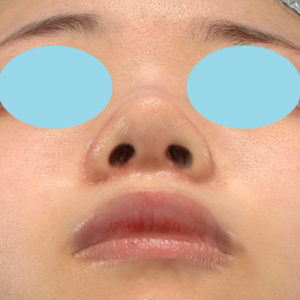 「小鼻縮小+α＋鼻尖縮小（close法）」　新宿ラクル美容外科クリニック　２０代女性　手術後１ヶ月目　８月１９日