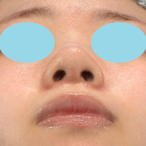 「小鼻縮小+α＋鼻尖縮小（close法）」　新宿ラクル美容外科クリニック　２０代女性　手術後２ヶ月目　８月１９日