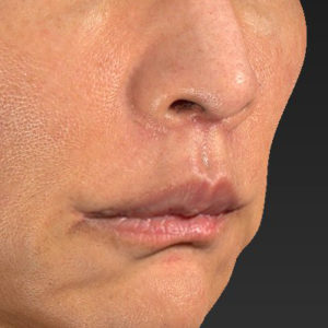 新宿ラクル美容外科クリニック　山本厚志　「人中短縮術（リップリフト）＋口角挙上（スマイルリップ）」　手術後２ヶ月目　８月２０日