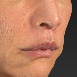 新宿ラクル美容外科クリニック　山本厚志　「人中短縮術（リップリフト）＋口角挙上（スマイルリップ）」　手術後３ヶ月目　８月２０日