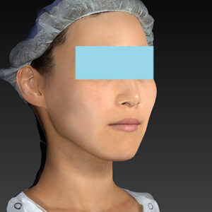 新宿ラクル美容外科クリニック　山本厚志　「アルテミスリフト」　手術後３ヶ月目　９月７日