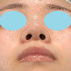 「小鼻縮小+α＋鼻尖縮小（close法）」　新宿ラクル美容外科クリニック　２０代女性　手術後３ヶ月目　９月１２日