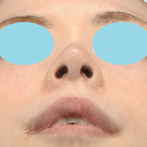 新宿ラクル美容外科クリニック　山本厚志　「小鼻縮小+α法 ＋ 鼻孔縁下降術」　手術後６ヶ月目　８月１２日