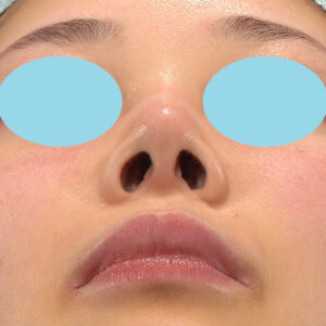 「耳介軟骨移植＋鼻尖縮小（close法）＋鼻プロテーゼ隆鼻術＋ハンプ切除＋猫手術＋真皮脂肪移植（鼻尖）」　新宿ラクル美容外科クリニック　２０代女性　手術後６ヶ月目　２月９日