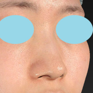 「小鼻縮小+α＋鼻尖縮小（close法）」　新宿ラクル美容外科クリニック　２０代女性　手術前　８月１９日