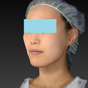 新宿ラクル美容外科クリニック　山本厚志　「アルテミスリフト」　手術前　８月５日