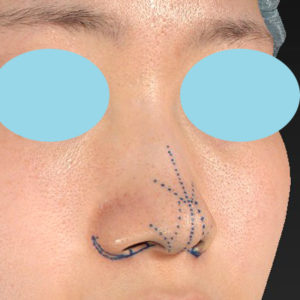 「小鼻縮小+α＋鼻尖縮小（close法）」　新宿ラクル美容外科クリニック　２０代女性　デザイン　８月１９日