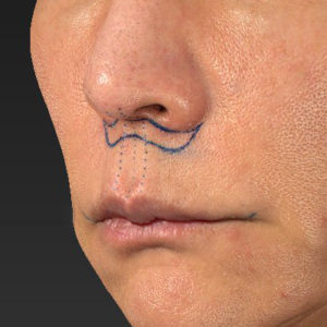 新宿ラクル美容外科クリニック　山本厚志　「人中短縮術（リップリフト）＋口角挙上（スマイルリップ）」　デザイン　８月２０日