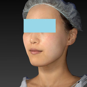 新宿ラクル美容外科クリニック　山本厚志　「アルテミスリフト」　手術直後　８月５日