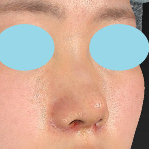 「小鼻縮小+α＋鼻尖縮小（close法）」　新宿ラクル美容外科クリニック　２０代女性　手術後１週間目　８月１９日