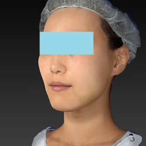 新宿ラクル美容外科クリニック　山本厚志　「アルテミスリフト」　手術後１週間目　８月５日