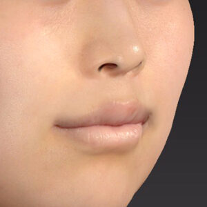 新宿ラクル美容外科クリニック　山本厚志　「猫手術（鼻唇角形成術）+ 貴族手術（鼻翼基部プロテーゼ）+ 口角挙上（スマイルリフト）+ 人中短縮術（リップリフト）」　手術後１２ヶ月目　２月１６日