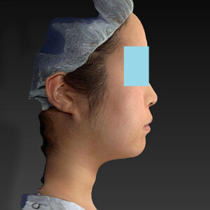 新宿ラクル美容外科クリニック　山本厚志　「ライポライフ脂肪吸引（ジョールファット+あご下）」　手術後１２ヶ月目　２月２１日