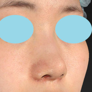 「小鼻縮小+α＋鼻尖縮小（close法）」　新宿ラクル美容外科クリニック　２０代女性　手術後１ヶ月目　８月１９日