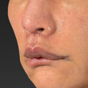 新宿ラクル美容外科クリニック　山本厚志　「人中短縮術（リップリフト）＋口角挙上（スマイルリップ）」　手術後１ヶ月目　８月２０日