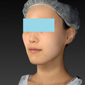 新宿ラクル美容外科クリニック　山本厚志　「アルテミスリフト」　手術後１ヶ月目　８月５日