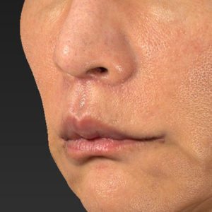 新宿ラクル美容外科クリニック　山本厚志　「人中短縮術（リップリフト）＋口角挙上（スマイルリップ）」　手術後２ヶ月目　８月２０日