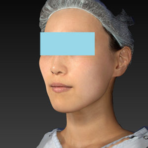 新宿ラクル美容外科クリニック　山本厚志　「アルテミスリフト」　手術後２ヶ月目　８月５日