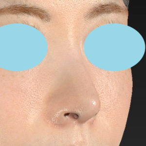 新宿ラクル美容外科クリニック　山本厚志　「小鼻縮小+α法 ＋ 鼻孔縁下降術」　手術後３ヶ月目　８月１２日